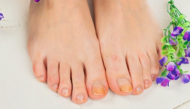 to treat a toenail fungus