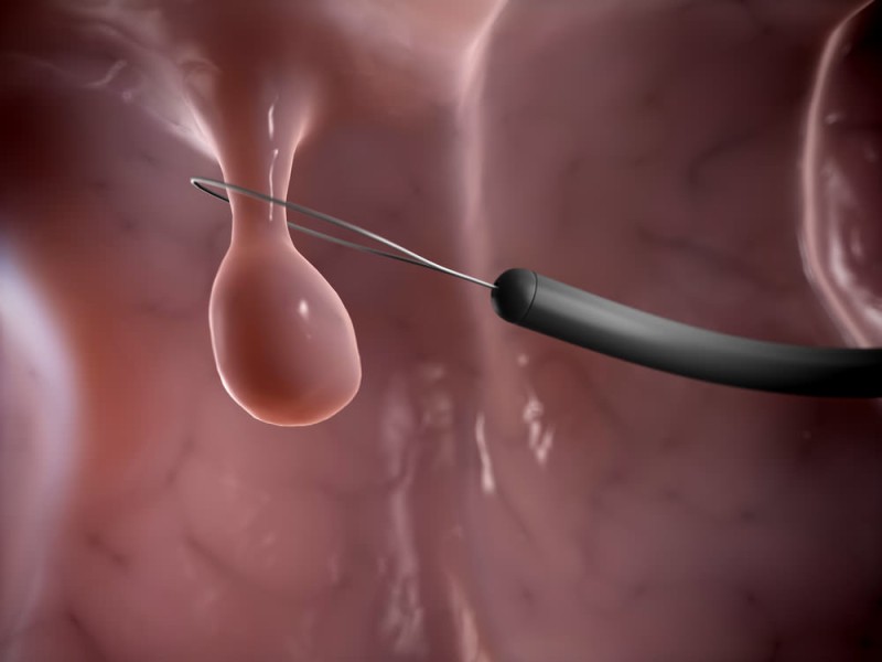 How to treat polyps of the uterus?