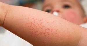prickly heat in infants