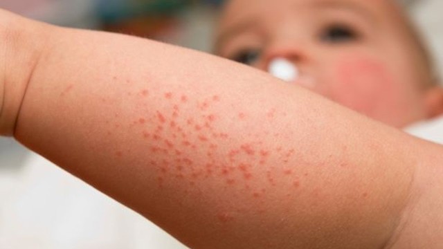prickly heat in infants
