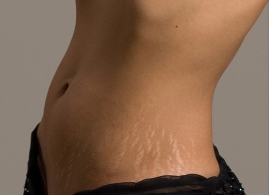 How to get rid of stretch marks