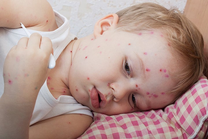 The symptoms of chicken pox